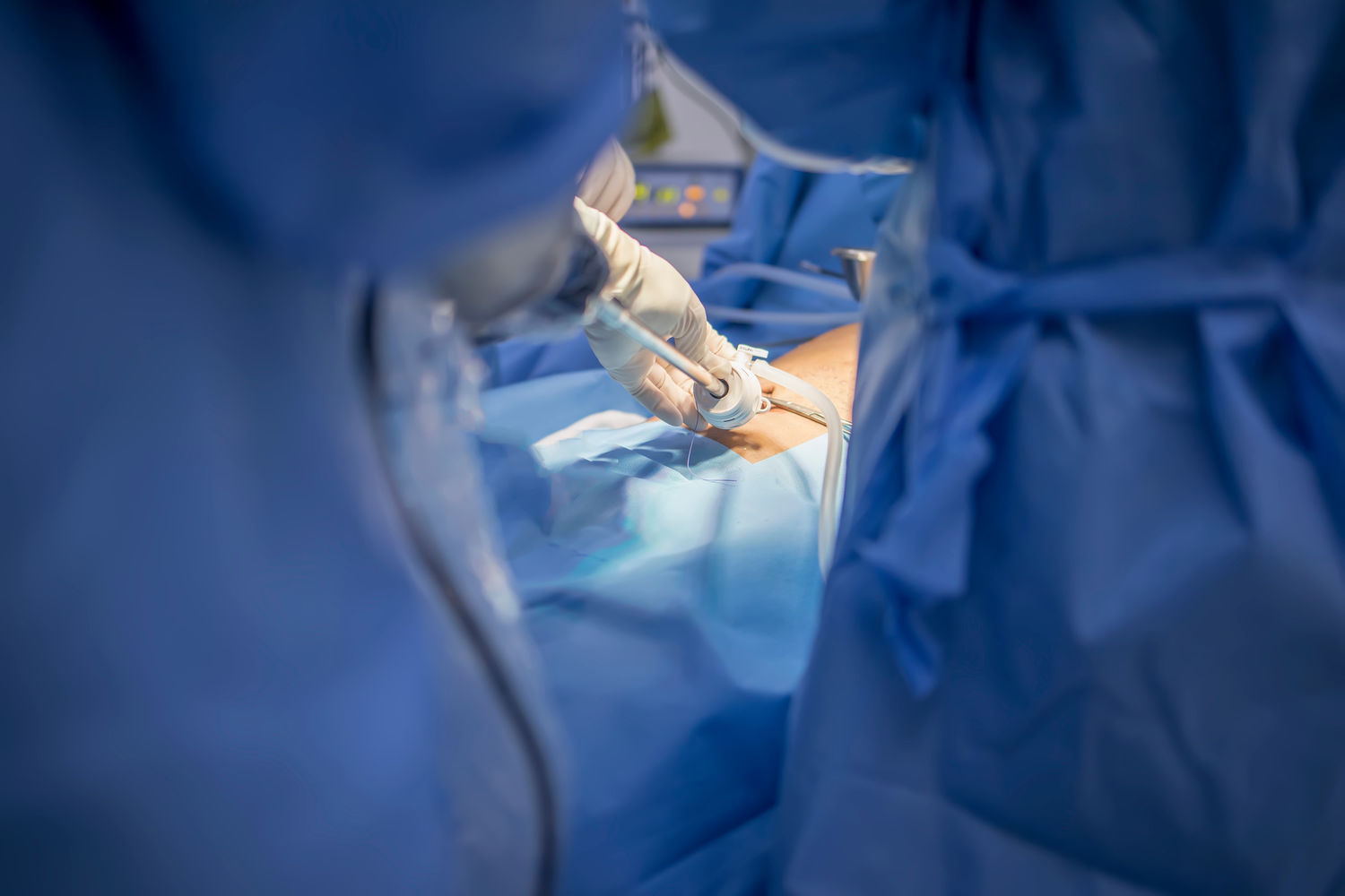Хирургические отсасыватели: Незаменимые помощники в хирургии