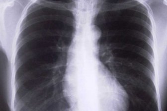 В Зеленограде школьная медсестра, которая работала с детьми, умерла от туберкулеза открытой формы