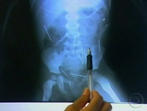 Бразильские врачи снова обнаружили швейные иголки в человеческом теле
