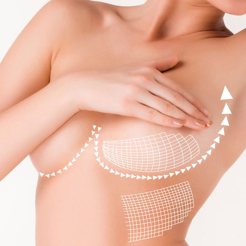 Альтернативные методы увеличения груди: что следует знать о липофилинге?