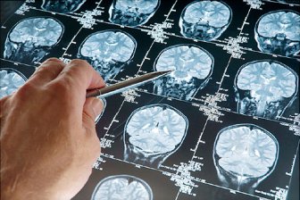 В РФ предложили лечить рак мозга при помощи «ядерных пуль»