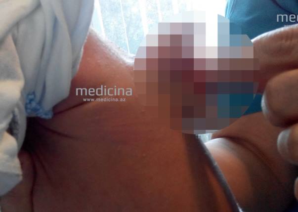 В Азербайджане успешно прооперировали ребенка родившегося со вторым пенисом на спине