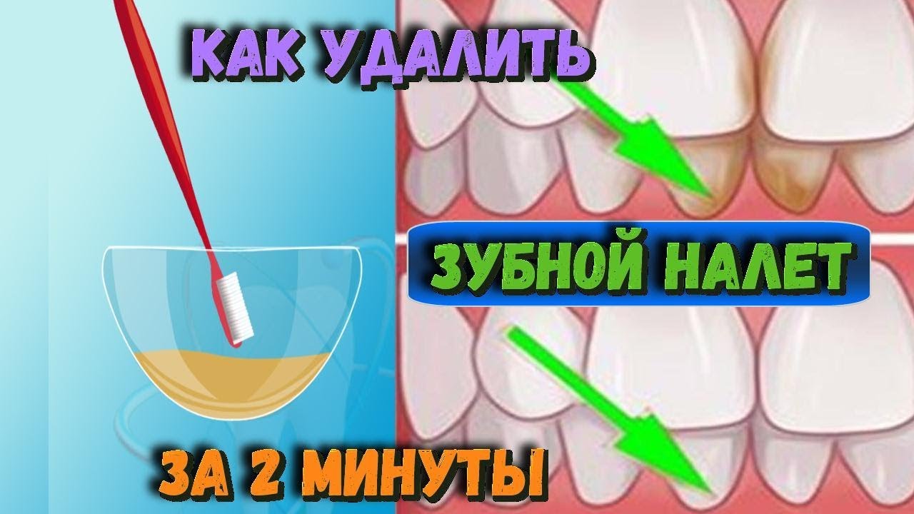Как удалить ЗУБНОЙ НАЛЕТ за 2 минуты Самое простое СРЕДСТВО от зубного камня Рецепт ЗДОРОВЬЯ