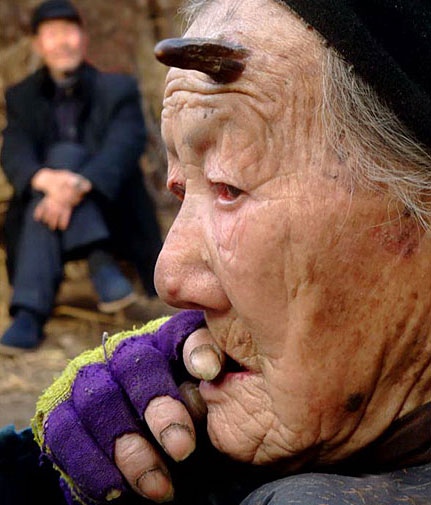 У 101-летней китаянки растут дьявольские рога