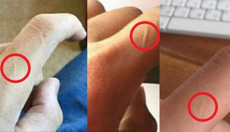 У многих людей нашли загадочный рубец на указательном пальце