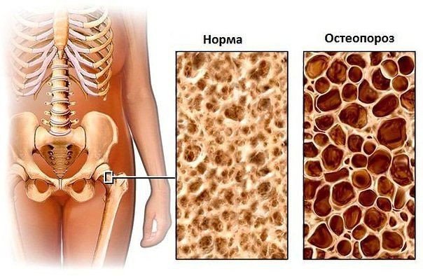 Остеопороз - болезнь любого возраста, профилактика и лечение