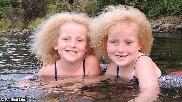 Единственные в мире близнецы с синдромом нерасчесываемых волос
