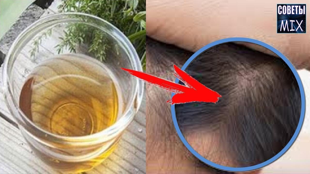 Сильно ВЫПАДАЮТ ВОЛОСЫ Остановить выпадение волос помогут эти 2 ингредиента Рецепт ЗДОРОВЫХ ВОЛОС