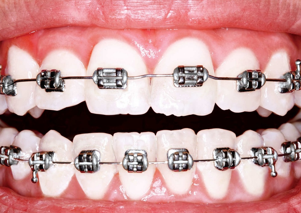 Вред и польза брекетов — чем полезны системы для зубов?